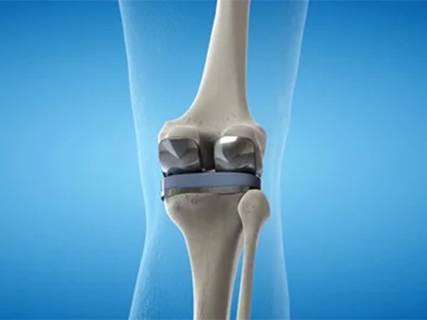 Joint Replacement Center